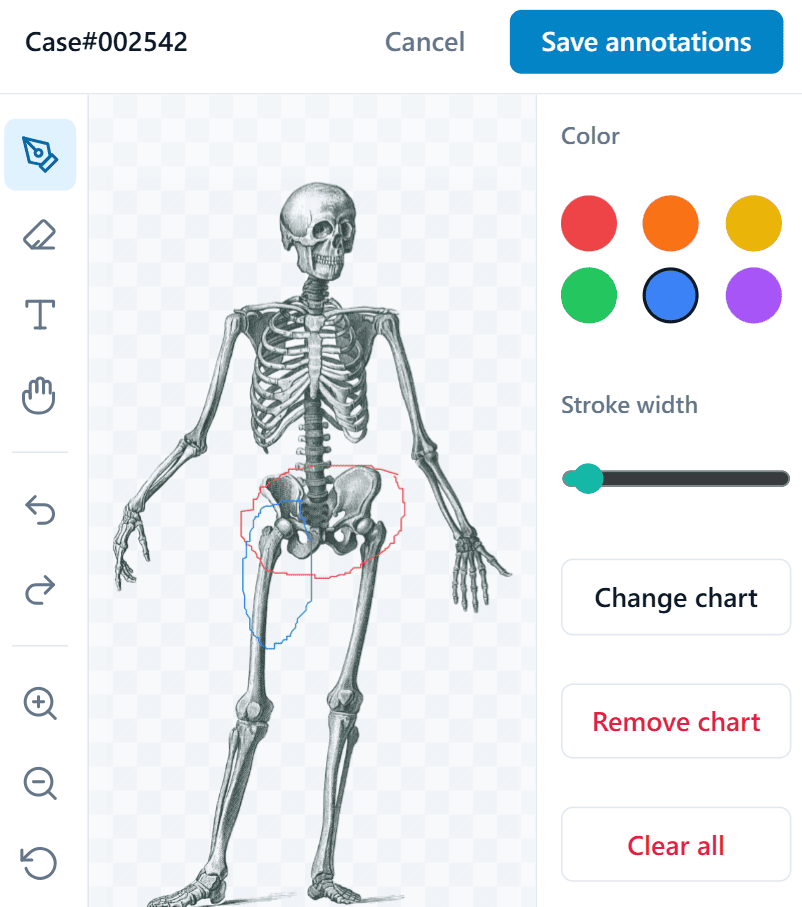Annotated skeleton chart with drawn markup on the hip and leg